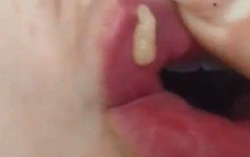 Kinh hoàng cảnh bác sĩ nặn mủ từ đôi môi bơm chất làm đầy
