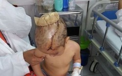 Bé gái bị chó hoang cắn rách đầu, hỏng mắt mong được giúp đỡ