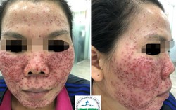 Gặp họa vì tin lời quảng cáo 'da trắng sáng nhanh chóng chỉ sau 1 lần lột'