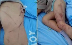 Bé trai 4 tuổi bị mẹ đánh trọng thương do ị đùn 