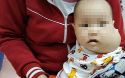 Khối u 'khổng lồ' khiến mặt bé 8 tháng tuổi biến dạng