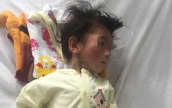 Bé gái 14 tháng nặng 3,5kg đã có biểu hiện thèm ăn