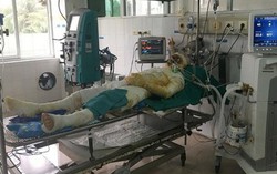 Tử vong vì trị bỏng bằng thuốc nam của thầy lang vườn