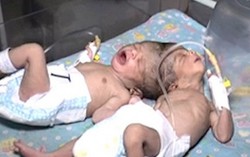 Mẹ đẻ con gái sinh đôi dính liền đầu ngay tại nhà
