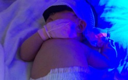 Bị dị tật hẹp tá tràng bẩm sinh hiếm gặp, thai nhi phải chào đời sớm