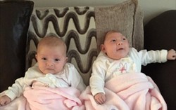 Sức sống mãnh liệt của em bé có não nằm ngoài hộp sọ 