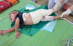 Ngã vào nồi măng đang nấu, bé 2 tuổi bị bỏng nặng bộ phận sinh dục