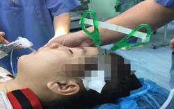 Bé 10 tuổi bị bạn dùng kéo đâm vào thái dương