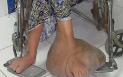 Giải cứu người phụ nữ 39 năm mang khối u 10kg 