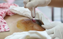 Đắp lá trị tắc tuyến sữa, sản phụ bị nhiễm trùng chảy mủ