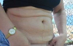 Bụng biến dạng sau hút mỡ: Thẩm mỹ viện Nhan sắc không được phép hút mỡ bụng