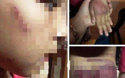 Cơ quan chức năng vào cuộc vụ bố bạo hành dã man con gái 8 tuổi ở Thanh Hóa