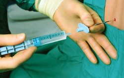 Loại thuốc tê nghi làm một sản phụ tử vong, một sản phụ nguy kịch ở Đà Nẵng là gì?