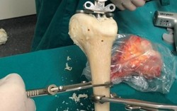 Dùng xương đồng loại, phương pháp mới điều trị ung thư xương