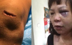 Khởi tố, bắt tạm giam kẻ lừa vợ lên đồi đánh đập, cắt gân ở Quảng Ninh