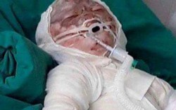 Bé 5 tuổi bỏng 70% cơ thể vì hàng xóm nướng mực