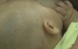 Bệnh nhi đầu tiên của Nghệ An bị viêm màng não do não mô cầu