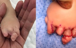 2 lần phẫu thuật tách ngón tay, chân dính liền cho bé gái gần 1 tuổi