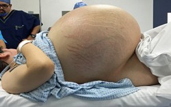Suýt suy tim vì u nang buồng trứng hơn 30 kg