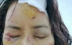 Hoàn thiện hồ sơ xử lý người chồng gây thương tích vợ cũ