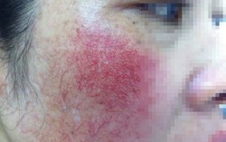 Da mặt lốm đốm, ửng đỏ sau dùng mỹ phẩm