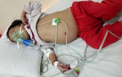 Bé gái dị dạng lồng ngực, suy tim, không tiền phẫu thuật