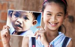 TP HCM mổ sứt môi - hở hàm ếch miễn phí