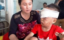 Chó gia đình nuôi 3 năm bất ngờ cắn bé 6 tuổi nát mặt, đứt tuyến lệ
