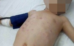 Cháu bé bị 'chồng hờ' của mẹ đánh nhập viện trong tình trạng hôn mê