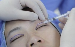Mắt trợn ngược sau một lần cắt mí làm đẹp