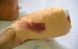 Sau dịp nghỉ Tết, nhiều bệnh nhân tiểu đường biến chứng nặng 