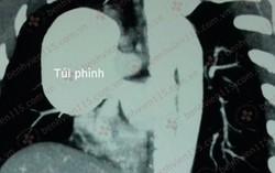 Nữ bệnh nhân bị phình tĩnh mạch chủ trên hiếm gặp