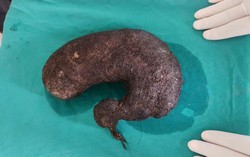 Hơn 12kg tóc trong bụng cô gái “nghiện ăn tóc"