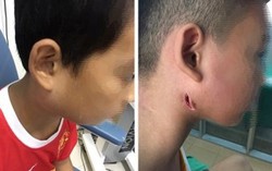Nghệ An: Điều trị thành công cho một cháu bé nhiễm 'vi khuẩn ăn thịt người'