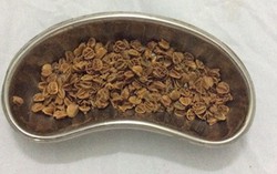 Hơn 70gr hạt sơri nảy mầm trong hậu môn bệnh nhi 11 tuổi