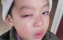 Lạng Sơn: Học sinh có nguy cơ hỏng mắt, nghi do bị cô giáo dùng thước đánh