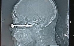 Đinh vít dài 10cm có móc đâm xuyên mặt