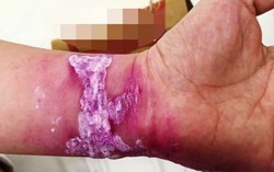 Đi tắm biển bị sứa tấn công, nữ du khách nhập viện cấp cứu