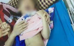 Bị chó to cắn khi chơi đùa, bé 6 tuổi dính một loạt vết thương hở
