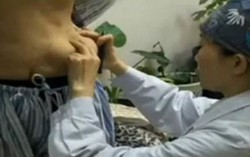 Miếng keo độn ngực trôi xuống bụng sau vài năm phẫu thuật