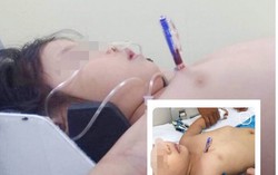 Bé gái 4 tuổi bị bút bi đâm thấu ngực