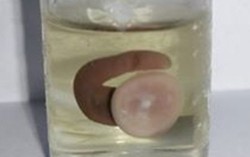 Uống nước suối vắt chui vào mũi