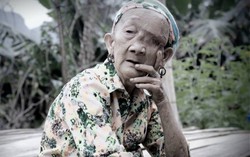 Giải thoát nỗi đau 20 năm mang u khổng lồ trên mặt
