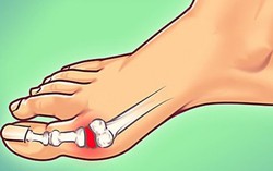 7 lời khuyên của bác sĩ giúp giảm nỗi đau bệnh gout