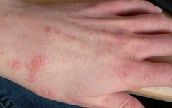 Tìm ra nguyên nhân khiến hơn 400 giáo viên, học sinh ở Điện Biên ngứa khắp cơ thể