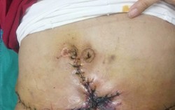 Hút mỡ bụng giảm béo: Đẹp đâu chưa thấy, chỉ thấy chằng chịt sẹo