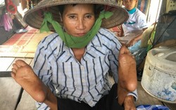 Mong manh đời người phụ nữ có chân mọc ngược