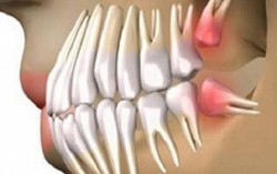 Tế bào gốc khiến răng mọc lại hoàn hảo trong 9 tuần
