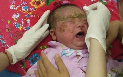Bé một tháng tuổi bị viêm da chảy mủ do tắm lá thuốc