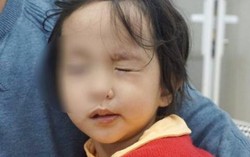 Trời rét đậm, rét hại, nhiều trẻ bị liệt mặt, méo miệng 